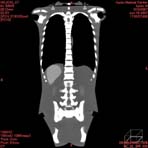 PBU CT Scan Front Torso