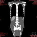 PBU CT Scan Front Torso