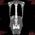 PBU CT Scan Front Torso