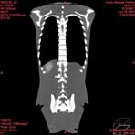 PBU CT Scan Front Torso