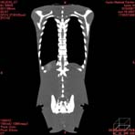 PBU CT Scan Front Torso