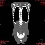 PBU CT Scan Front Torso