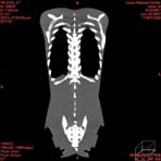 PBU CT Scan Front Torso