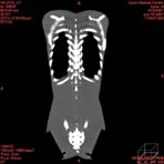 PBU CT Scan Front Torso