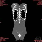 PBU CT Scan Front Torso