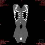 PBU CT Scan Front Torso