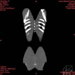 PBU CT Scan Front Torso