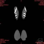 PBU CT Scan Front Torso