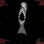 PBU CT Scan Side Torso