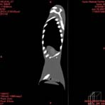PBU CT Scan Side Torso