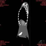 PBU CT Scan Side Torso