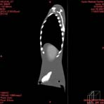 PBU CT Scan Side Torso
