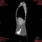 PBU CT Scan Side Torso
