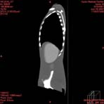 PBU CT Scan Side Torso