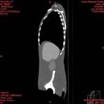 PBU CT Scan Side Torso