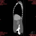 PBU CT Scan Side Torso