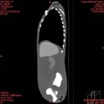 PBU CT Scan Side Torso