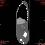 PBU CT Scan Side Torso
