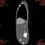 PBU CT Scan Side Torso