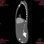 PBU CT Scan Side Torso