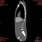 PBU CT Scan Side Torso