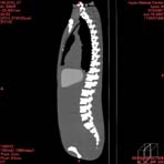 PBU CT Scan Side Torso
