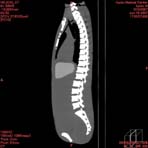 PBU CT Scan Side Torso