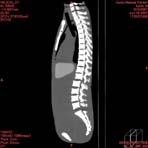 PBU CT Scan Side Torso