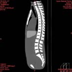 PBU CT Scan Side Torso