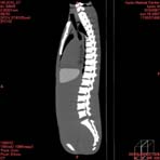 PBU CT Scan Side Torso