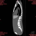 PBU CT Scan Side Torso