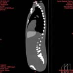 PBU CT Scan Side Torso