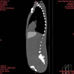 PBU CT Scan Side Torso