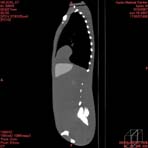 PBU CT Scan Side Torso