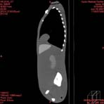 PBU CT Scan Side Torso