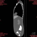PBU CT Scan Side Torso