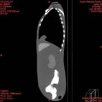 PBU CT Scan Side Torso