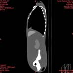 PBU CT Scan Side Torso