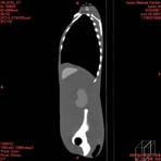 PBU CT Scan Side Torso