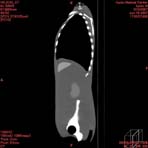 PBU CT Scan Side Torso