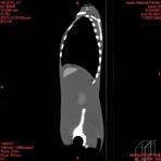 PBU CT Scan Side Torso