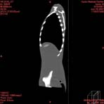 PBU CT Scan Side Torso