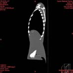 PBU CT Scan Side Torso