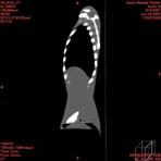 PBU CT Scan Side Torso