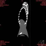 PBU CT Scan Side Torso