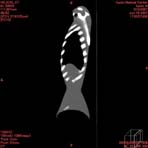 PBU CT Scan Side Torso