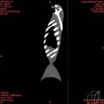 PBU CT Scan Side Torso