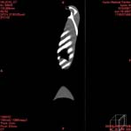 PBU CT Scan Side Torso