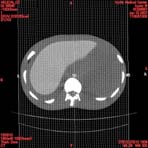 PBU CT Scan Torso Slice