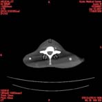PBU CT Scan Torso Slice